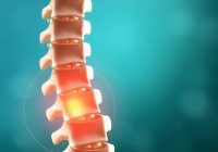 Wyślizgnięty dysk kręgosłupa – przyczyny, objawy i leczenie