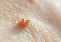 Wrastające włoski – przyczyny, objawy i skuteczne metody zapobiegania Wrastające włoski – przyczyny, objawy i skuteczne metody zapobiegania