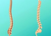 Rehabilitacja skoliozy – kluczowe metody i ich znaczenie