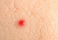 Swędzenie skóry – przyczyny, objawy i skuteczne leczenie