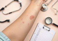 Jakie badania są potrzebne do diagnostyki swędzenia skóry? Jakie badania są potrzebne do diagnostyki swędzenia skóry?